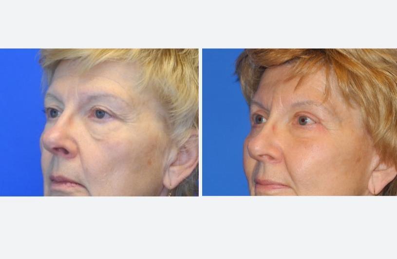 Eyelid Rejuvenation Left Oblique Before and After